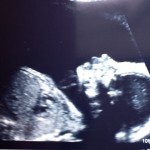 Ultrasound Pictures of Baby